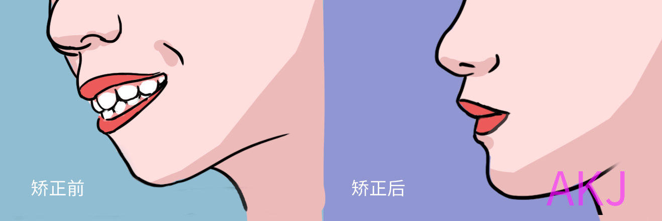 嘴突矯正