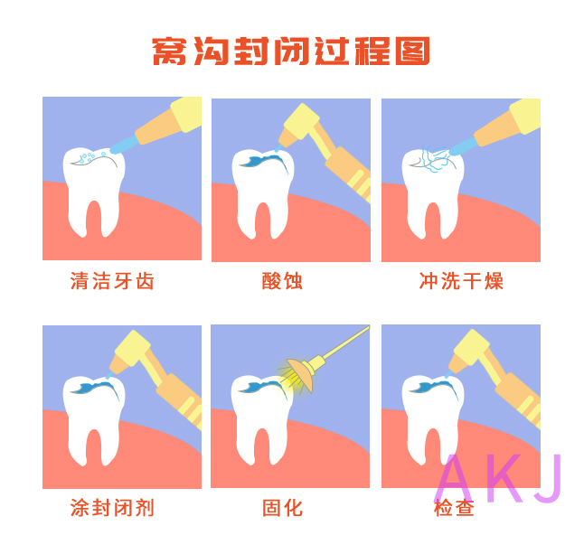 窩溝封閉