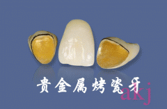 烤瓷牙不就是全瓷牙嗎？