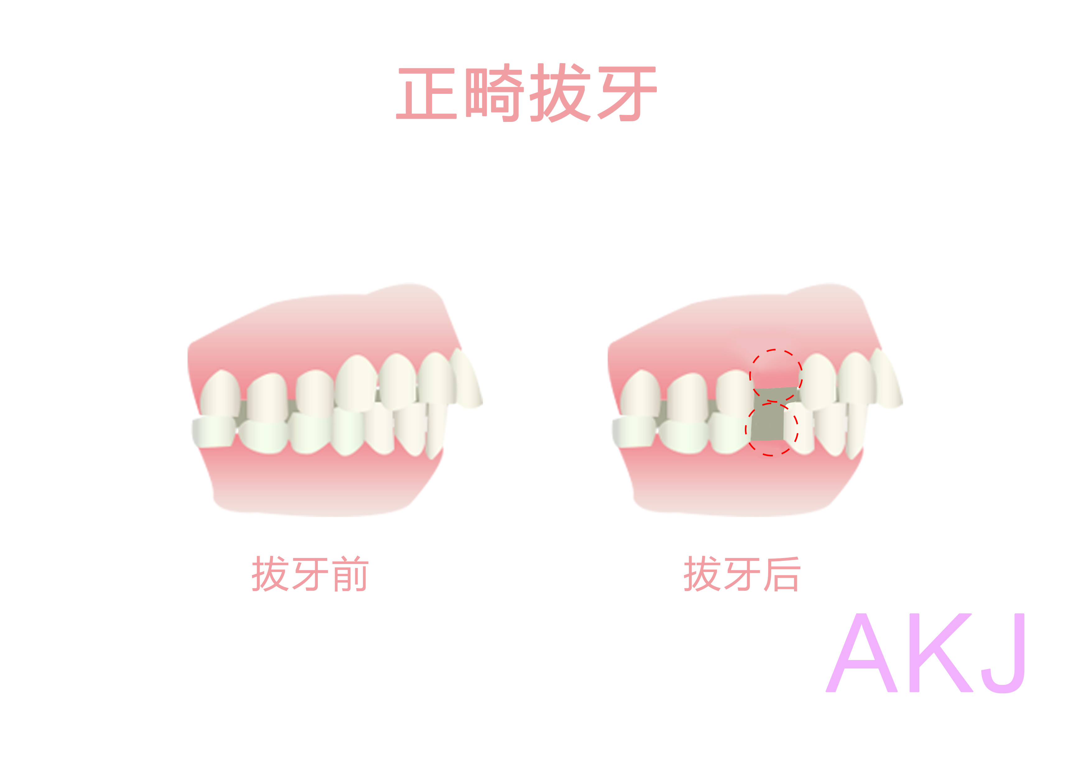 拔牙矯正