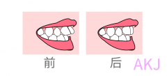 兒童牙齒前突什麽年齡矯正？牙齒前突矯正多少錢？