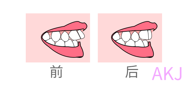 齙牙