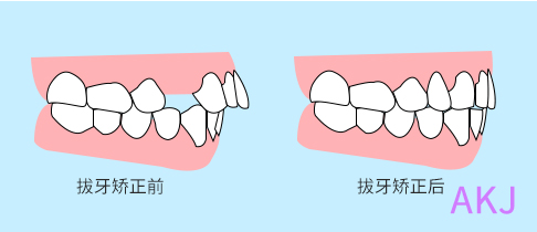 矯正