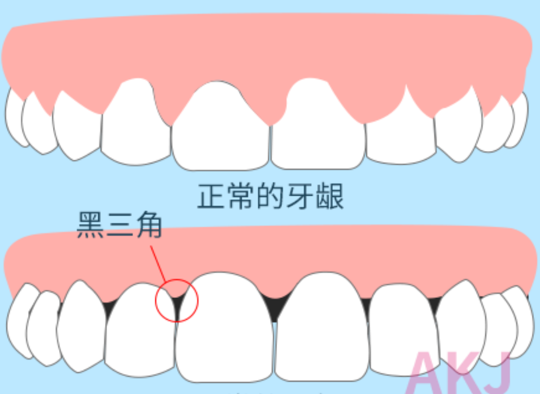 牙齦萎縮