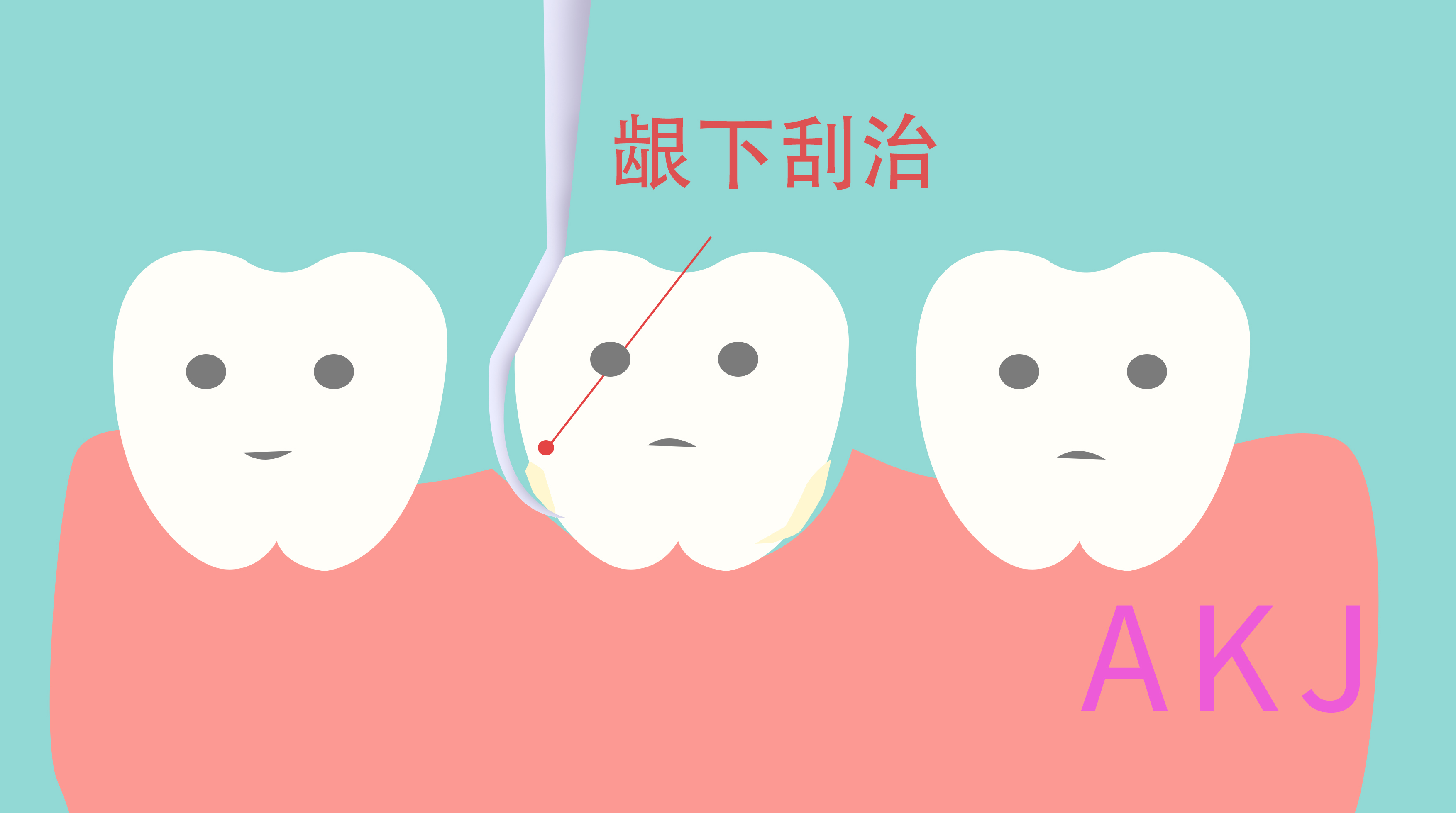 齦下刮治