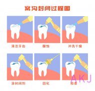 愛康健口腔科普：窩溝封閉的價格是多少？醫保能報銷嗎？