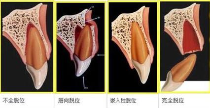 深圳牙脫位應該重視嗎?